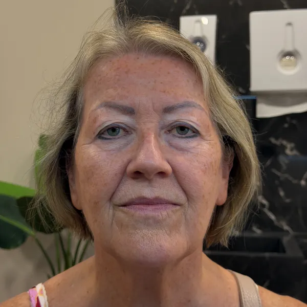 Avaliação pré-operatória de dermatochalasis palpebral com o Dr. Daniel Guedes Condição Pré-operatória de excesso de pele palpebral - Antes