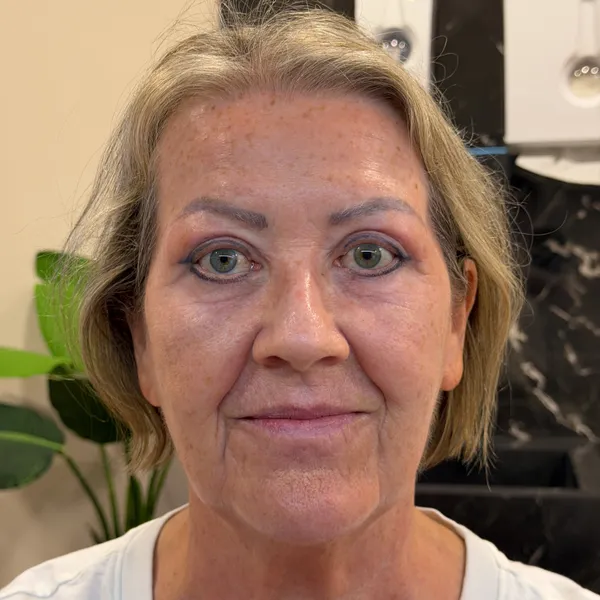 Blefaroplastia Superior a Laser: resultado de rejuvenescimento palpebral natural Resultado Pós-operatório de Blefaroplastia Superior a Laser - Depois