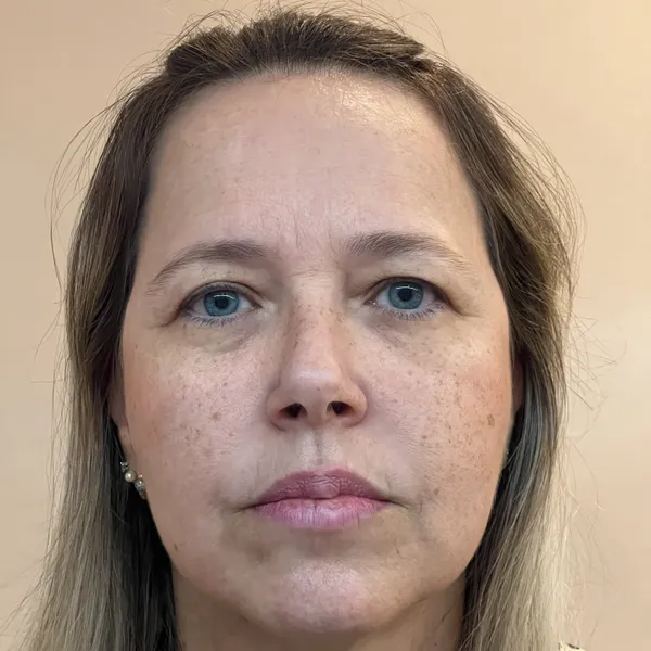 Avaliação prévia de ptose superciliar lateral Condição Pré-operatória de queda de supercílio - Antes