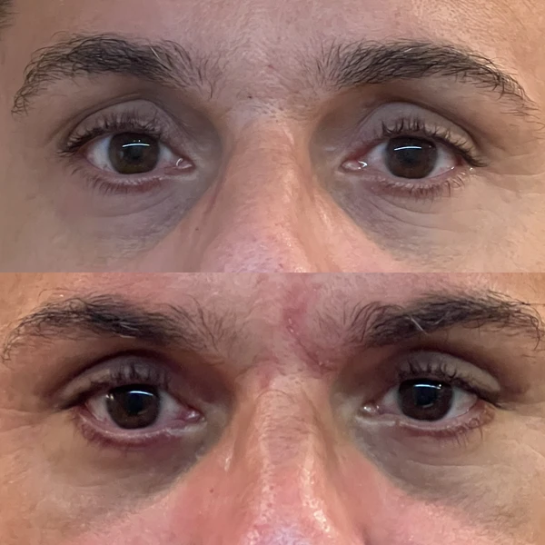 Resultado Clínico de Blefaroplastia #4 - Dr. Daniel Guedes Cirurgião Oftalmologista CRM-PB 8396 Caso Clínico #4 de Blefaroplastia e Rejuvenescimento do Olhar - Dr. Daniel Guedes em João Pessoa