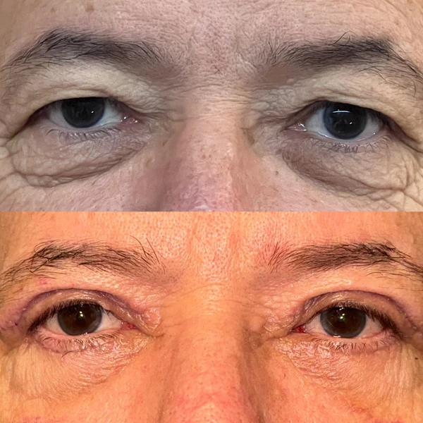 Resultado Clínico de Blefaroplastia #5 - Dr. Daniel Guedes Cirurgião Oftalmologista CRM-PB 8396 Caso Clínico #5 de Blefaroplastia e Rejuvenescimento do Olhar - Dr. Daniel Guedes em João Pessoa