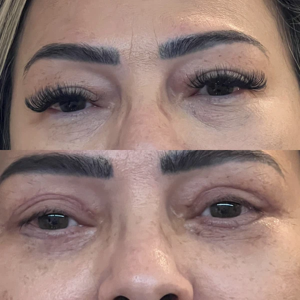 Resultado Clínico de Blefaroplastia #7 - Dr. Daniel Guedes Cirurgião Oftalmologista CRM-PB 8396 Caso Clínico #7 de Blefaroplastia e Rejuvenescimento do Olhar - Dr. Daniel Guedes em João Pessoa